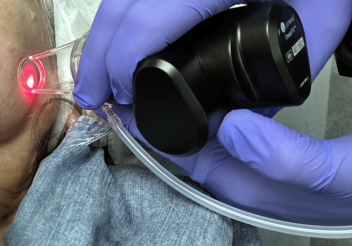 CO2 laser resurfacing treatment with the ULTRApulse Alpha at Hollywood Eye Institute
