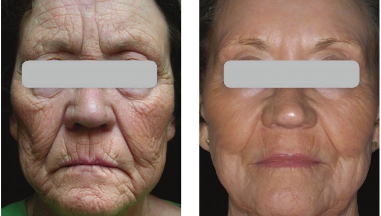 Before and after full-face CO2 laser resurfacing for deep wrinkles
