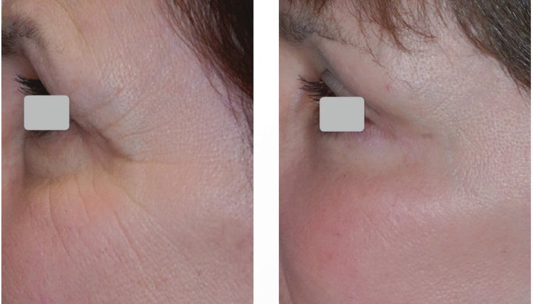 Before and after CO2 laser resurfacing for crow’s feet