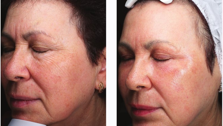 Before and after CO2 laser resurfacing for sun damage and wrinkles