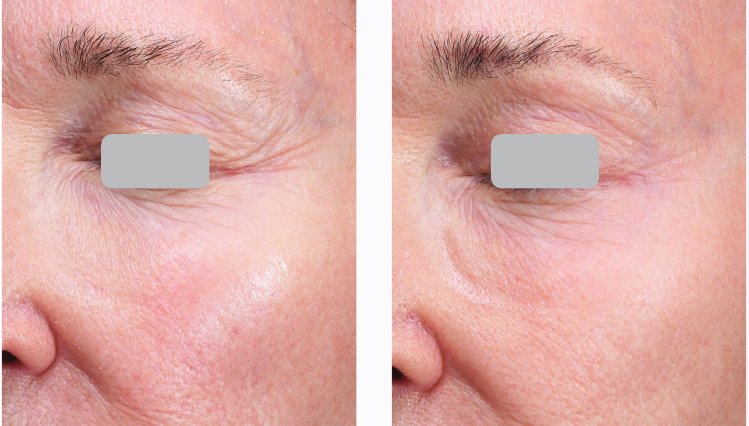 Before and after CO2 laser resurfacing for crepey under-eye skin